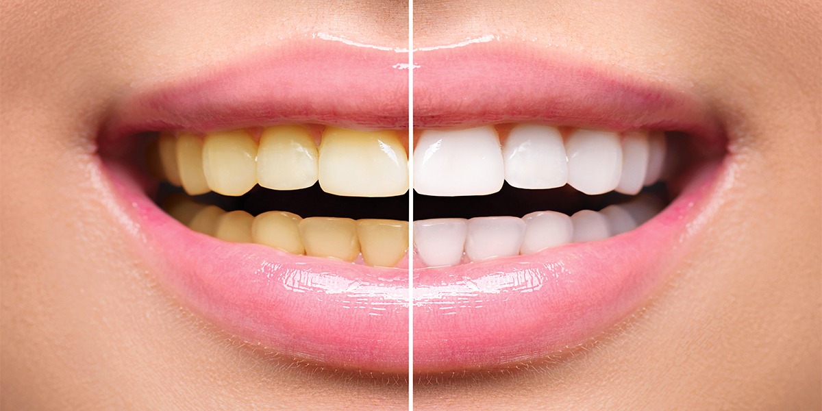 handel Doordeweekse dagen Productie Verkleurde tanden - Tandartspraktijk Reusel